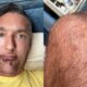 Actor porno gay comparte su "brutal" experiencia con la viruela del mono
